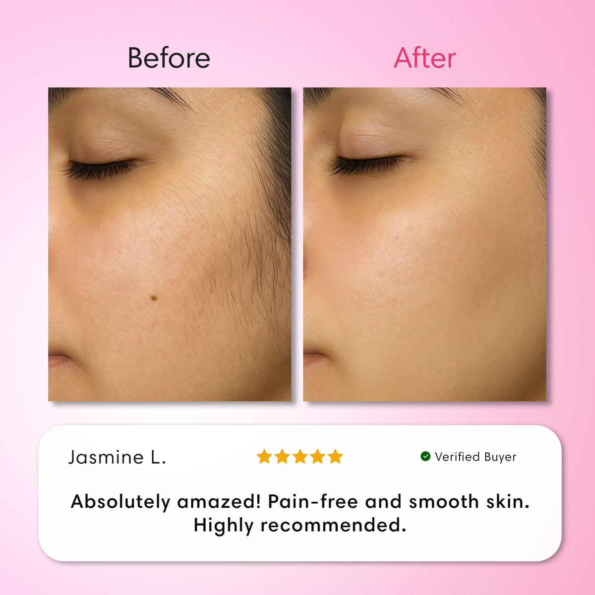 Hair Removal Trilogy Kit